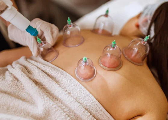 16554-cupping-therapy