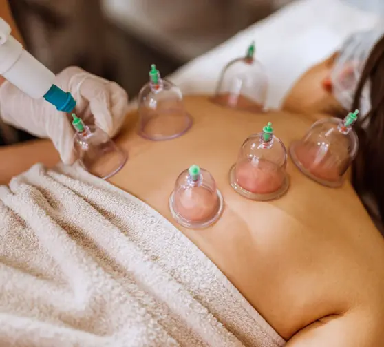 16554-cupping-therapy