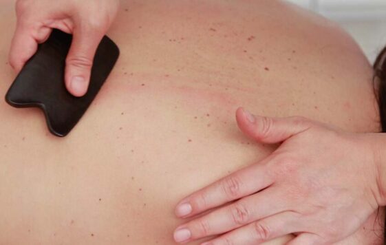 Traditional Chinese medicine Gua Sha
