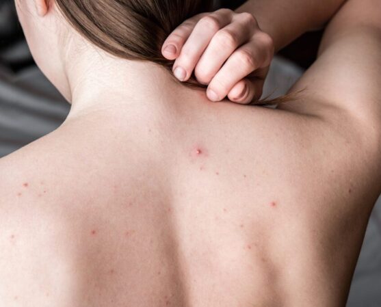 Problem skin. Young woman's back with acne, pimples and red spots.